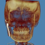 3D CT scan: lateral skull view with golden-brown rendering, blue background, dental structures visible