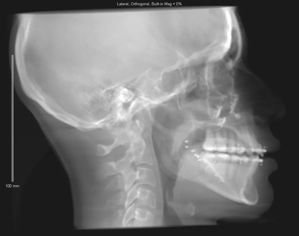 Lateral skull X-ray with dental implants, cervical spine, and visible maxillary sinus