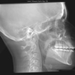 Lateral skull X-ray with dental implants, cervical spine, and visible maxillary sinus