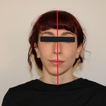 Close-up facial photo showing nasal/lip symmetry assessment with red midline