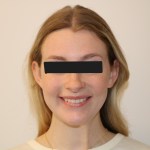 Frontal view: female patient with light brown hair, neutral expression, black top, eyes obscured