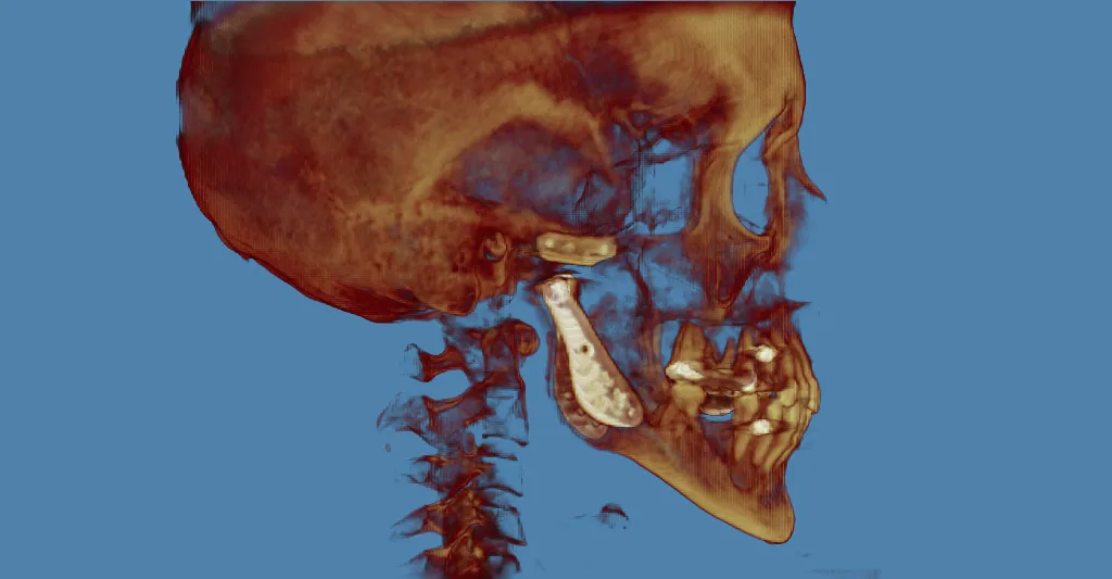 3D CT scan: rotated lateral skull view with golden-brown rendering, neck/spine visible