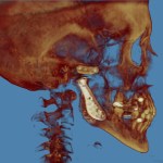 3D CT scan: rotated lateral skull view with golden-brown rendering, neck/spine visible
