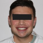 Frontal view: male patient with neutral expression, eyes obscured