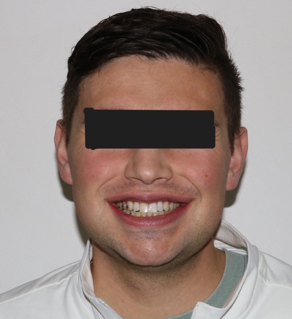 Frontal view: male patient with neutral expression, eyes obscured