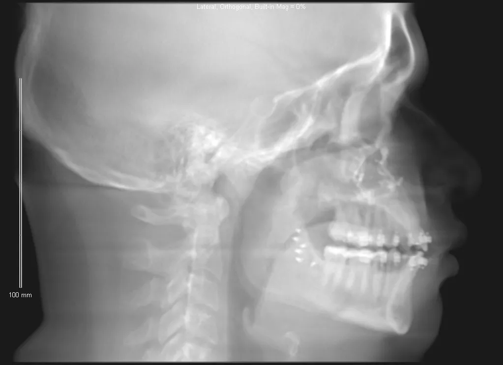 Grayscale lateral skull X-ray showing jaw, teeth, and cervical spine