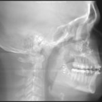 Grayscale lateral skull X-ray showing jaw, teeth, and cervical spine
