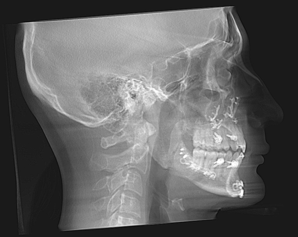 Grayscale lateral skull X-ray showing jaw, teeth, and cervical spine