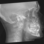 Grayscale lateral skull X-ray showing jaw, teeth, and cervical spine