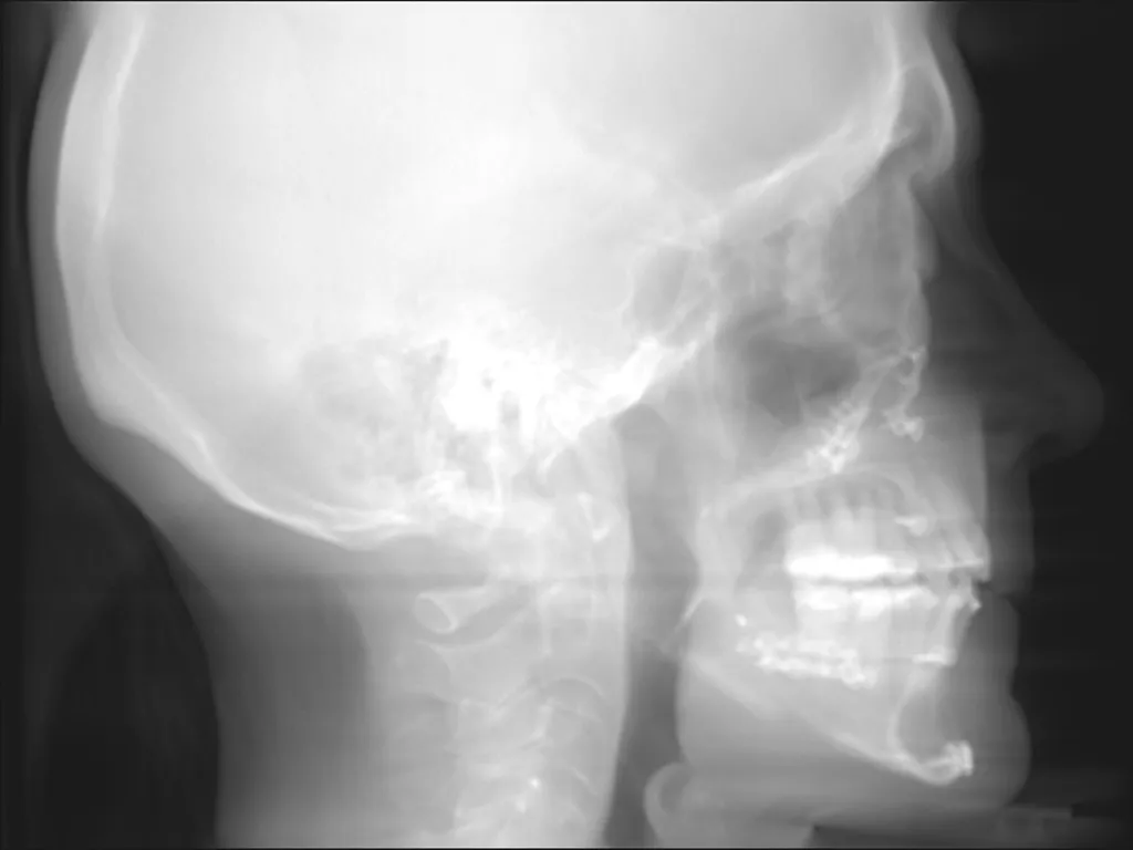 Lateral skull X-ray with visible dental structures and cervical spine