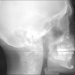 Lateral skull X-ray with visible dental structures and cervical spine