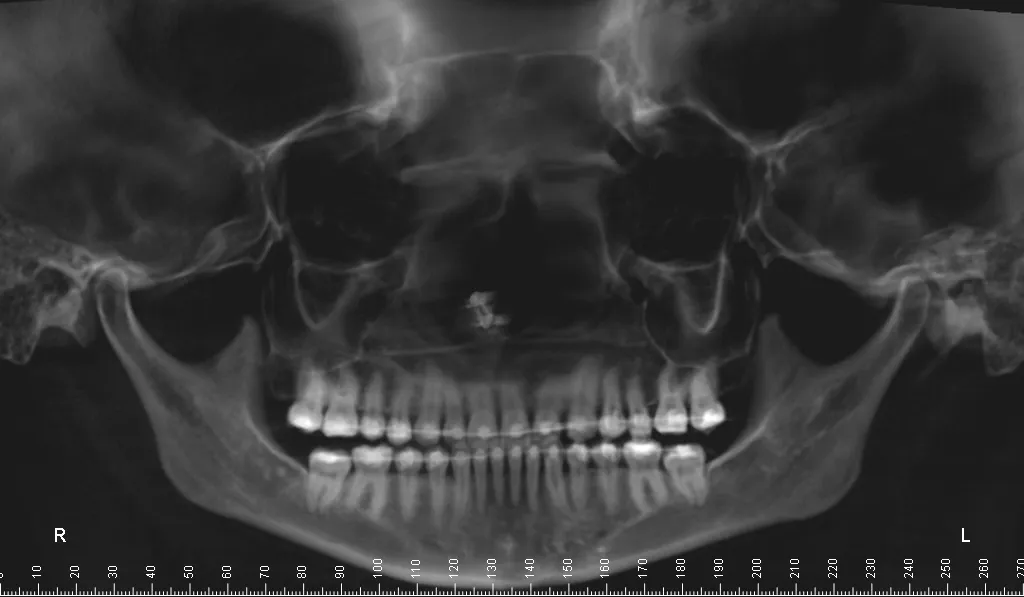 Panoramic dental X-ray showing full dentition and jaw