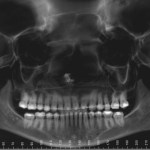 Panoramic dental X-ray showing full dentition and jaw