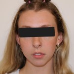 Frontal view: female patient with brown hair tied up, smiling, black top, eyes obscured