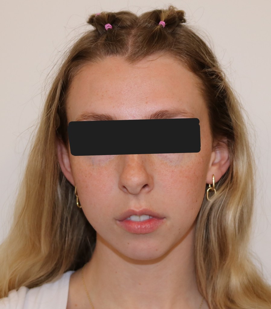Frontal view: female patient with brown hair tied up, smiling, black top, eyes obscured