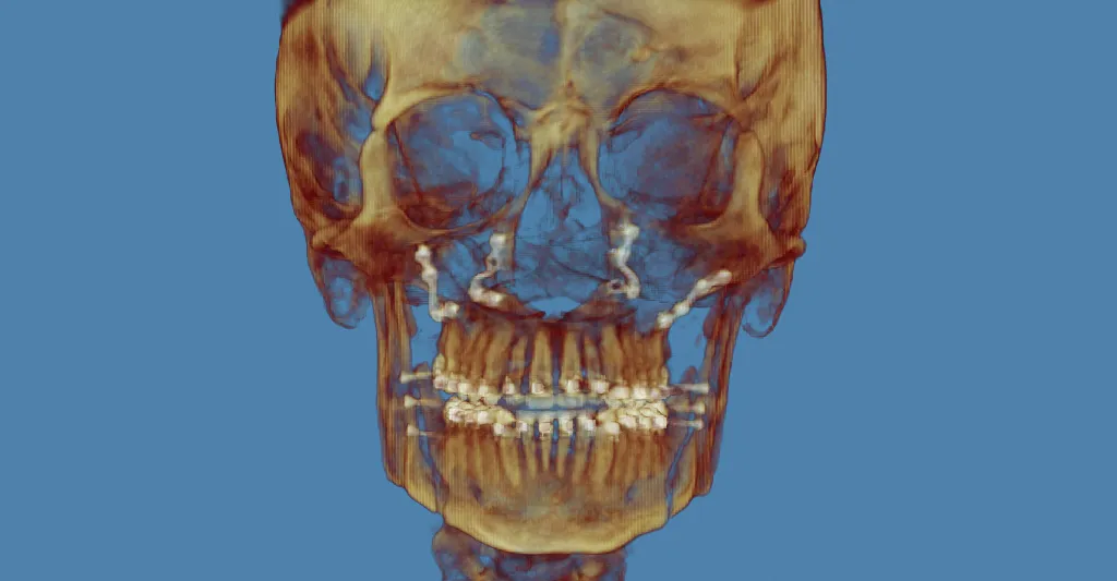3D skull model in golden-brown tones with orthodontic wires on teeth, blue background
