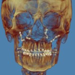 3D skull model in golden-brown tones with orthodontic wires on teeth, blue background