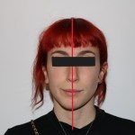 Frontal facial photo with red vertical midline marker, eyes obscured, black top