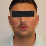 Frontal view: male patient with neutral expression, eyes obscured