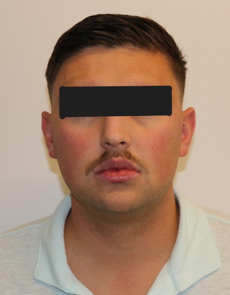 Frontal view: male patient with neutral expression, eyes obscured