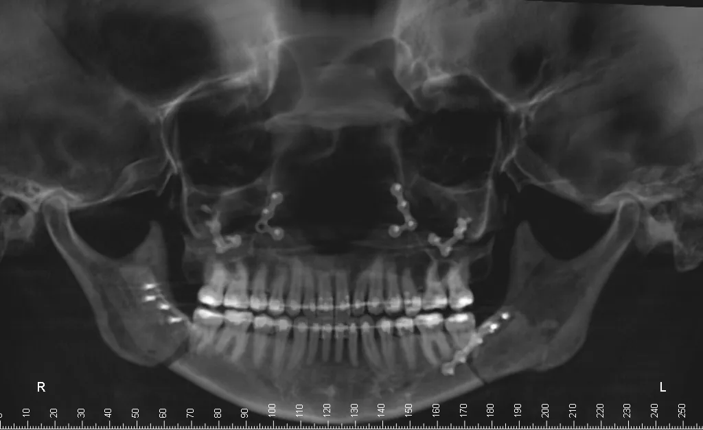 Panoramic dental X-ray showing full dentition and jaw