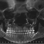 Panoramic dental X-ray showing full dentition and jaw