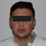 Frontal view: male patient with neutral expression, eyes obscured