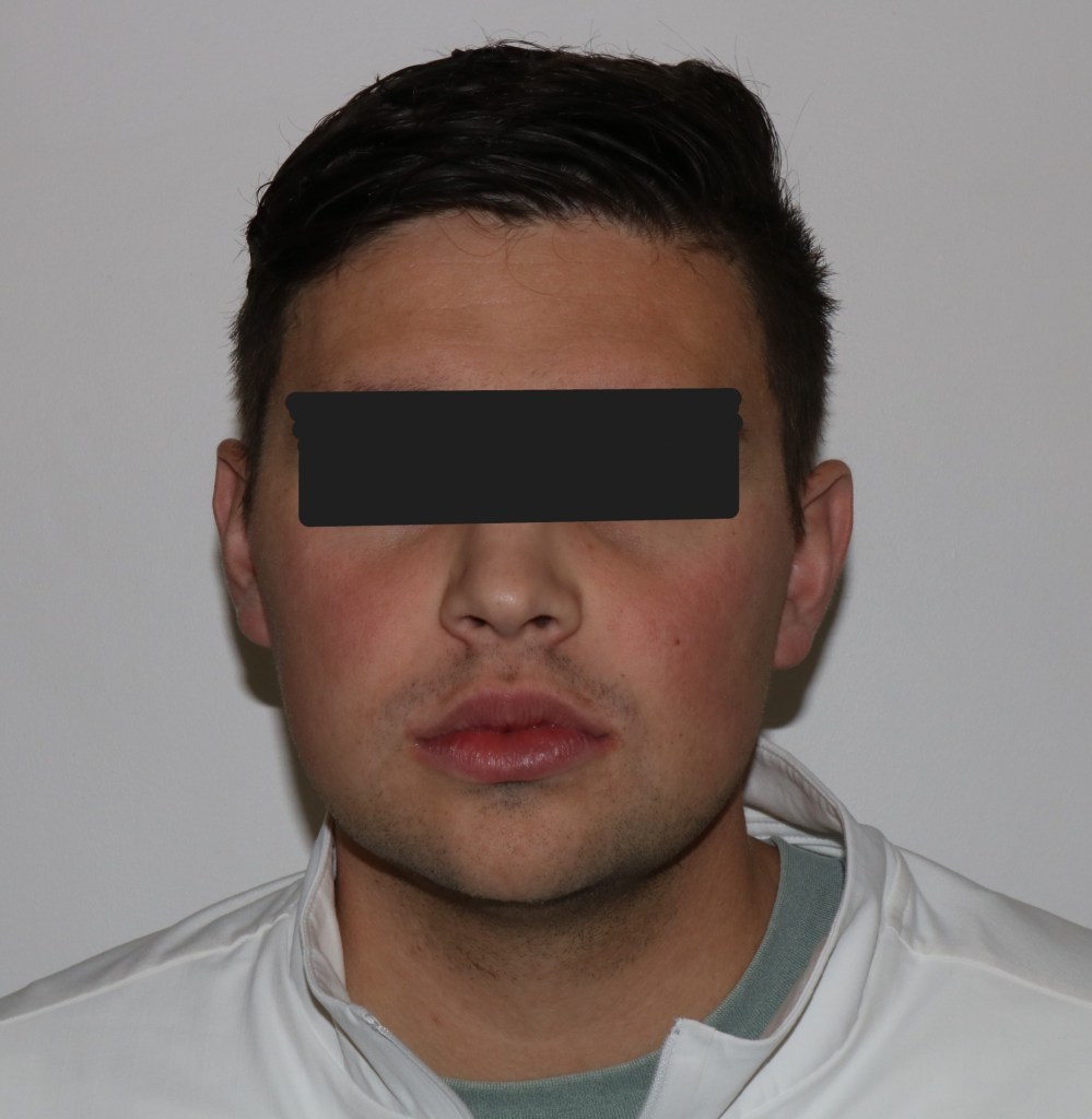 Frontal view: male patient with neutral expression, eyes obscured