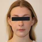 Frontal view: female patient with light brown hair, neutral expression, black top, eyes obscured