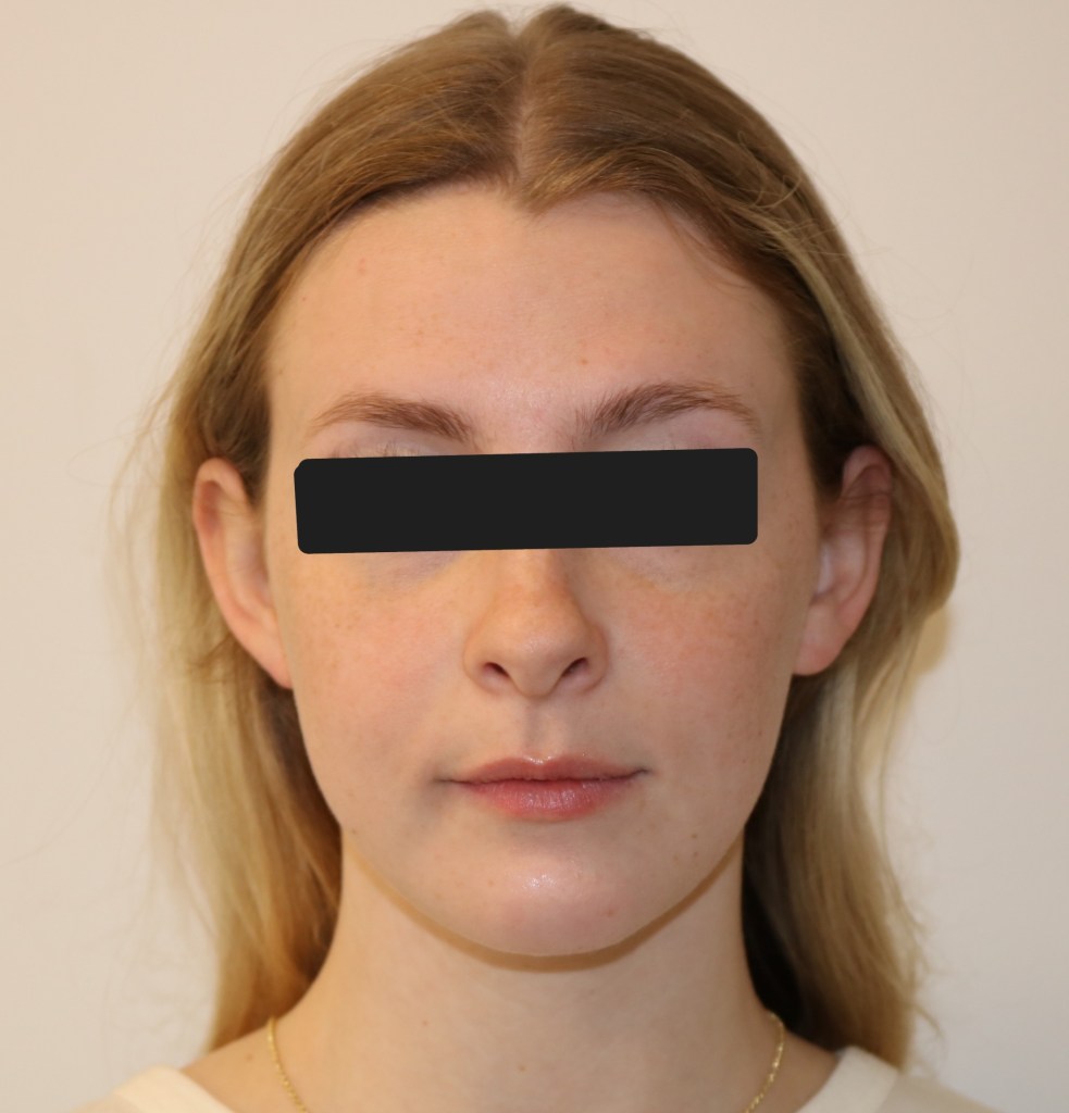 Frontal view: female patient with light brown hair, neutral expression, black top, eyes obscured