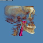 3D skull model with jaw highlighted in red and purple, blue background