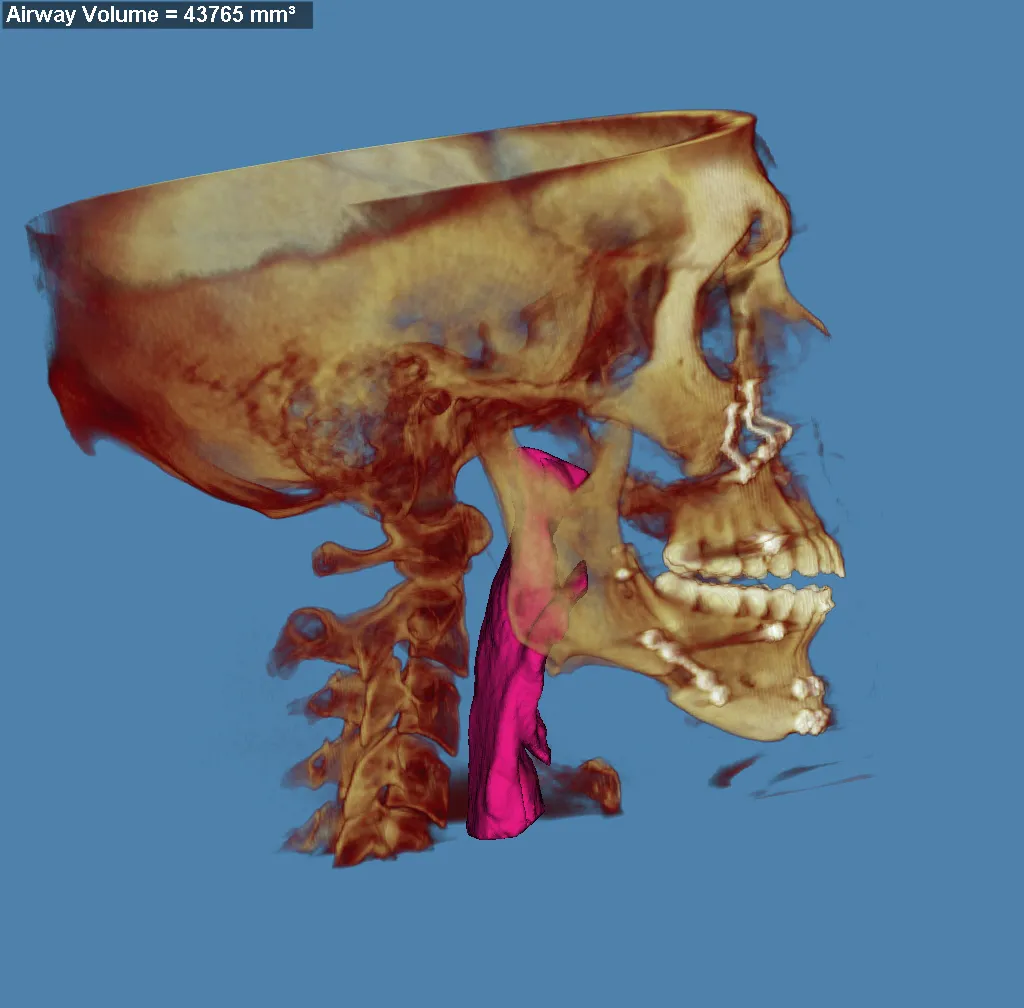 3D skull model with jaw highlighted in red and purple, blue background