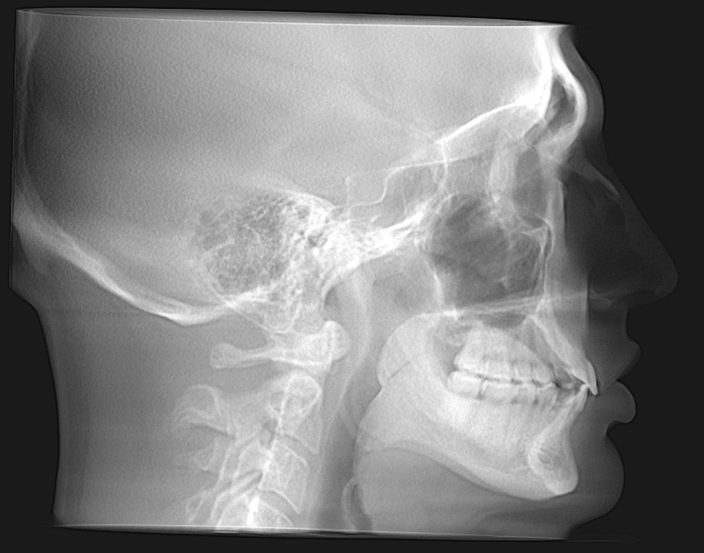 Lateral skull X-ray showing dental work, cervical spine, and intact maxillary sinus