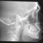 Lateral skull X-ray showing dental work, cervical spine, and intact maxillary sinus