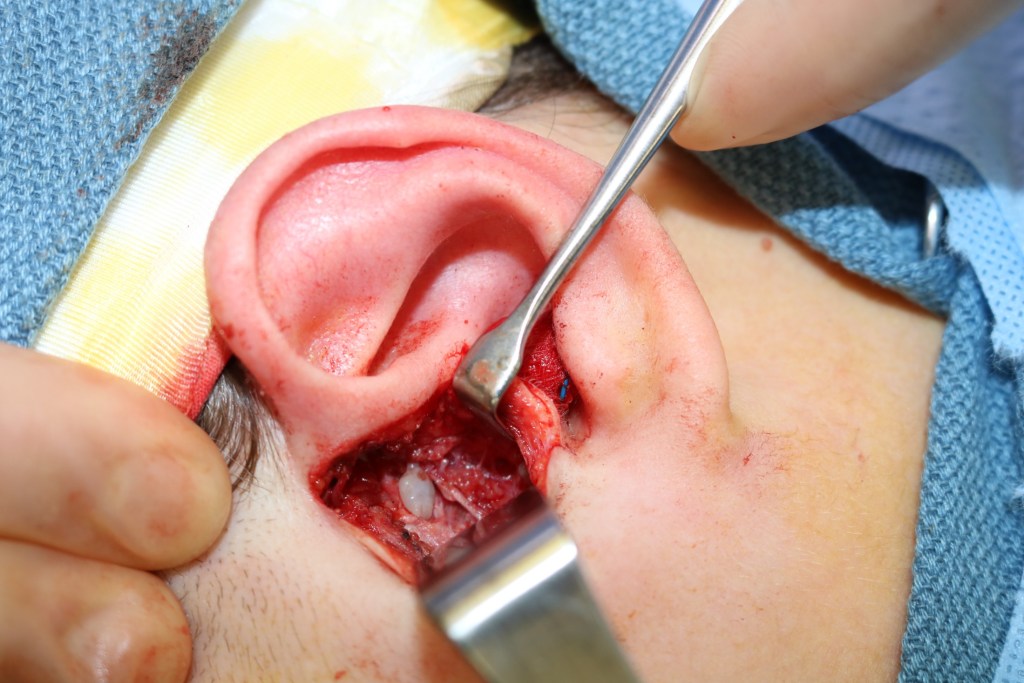 Intraoperative ear surgery: retractor holding incision, surgical instrument, and blood at site