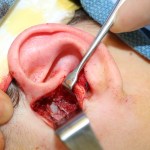 Intraoperative ear surgery: retractor holding incision, surgical instrument, and blood at site