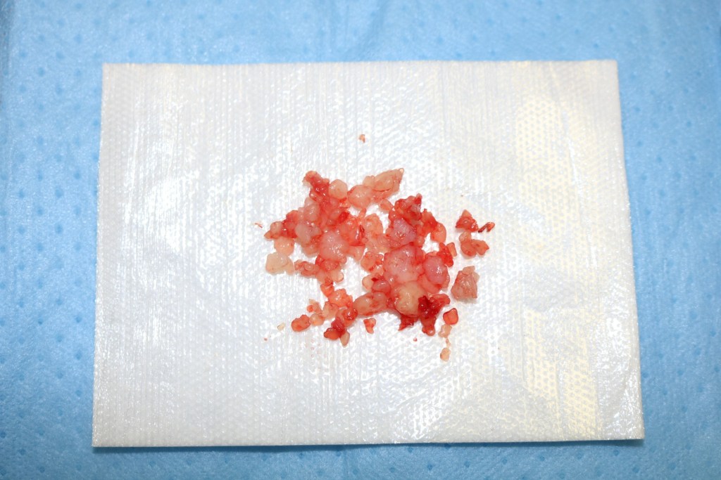 Small pile of red and pink tissue fragments on white surgical drape