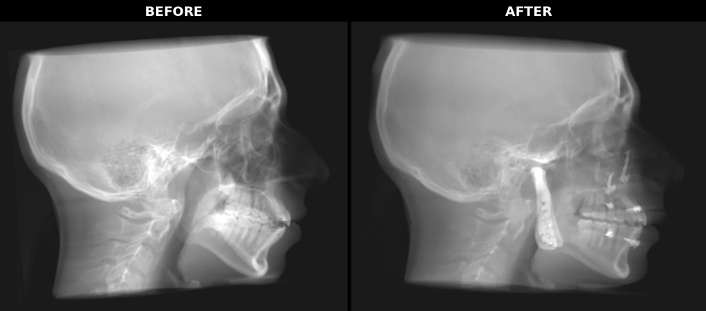 Before and after TMJ surgery