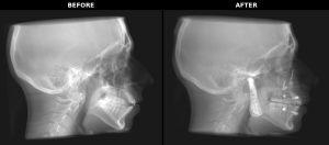 Before and after TMJ surgery